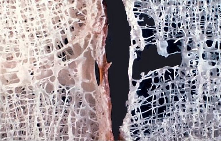 Gesundes (li) und durch Osteoporose geschädigtes (re) Knochengewebe. Quelle: MSD, München
