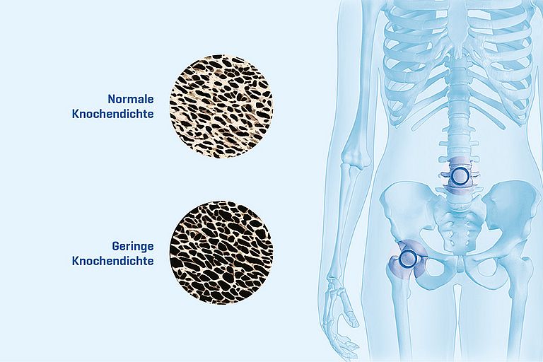 Die Osteoporose ist eine häufige Alterserkrankung des Knochens, die ihn anfällig für Brüche macht. Die auch als Knochenschwund bezeichnete Krankheit ist gekennzeichnet durch eine Abnahme der Knochendichte. Man geht davon aus, dass in Deutschland etwa 30 Prozent aller Frauen ab einem Alter von 50 Jahren an primärer Osteoporose erkranken. Für Männer ist ab dem 70. Lebensjahr die Altersosteoporose ein ebenso häufiges Krankheitsbild. Häufige Knochenbrüche infolge einer Osteoporose sind Wirbelkörper-­Einbrüche und hüftgelenksnahe Oberschenkelknochenbrüche. Abbildungen: BruceBlaus (CC BY-SA 4.0)